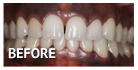 Best Gum Bleaching in Los Angeles Best Gum Bleaching in Los Angeles