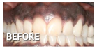 Best Gum Bleaching in Los Angeles Best Gum Bleaching in Los Angeles